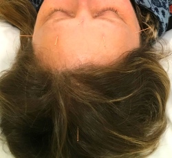 Photo of acupuncture for migraine